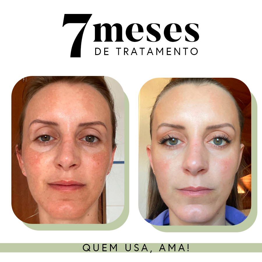 Fórmula Uniformizadora para Manchas e Melasma | 35 g