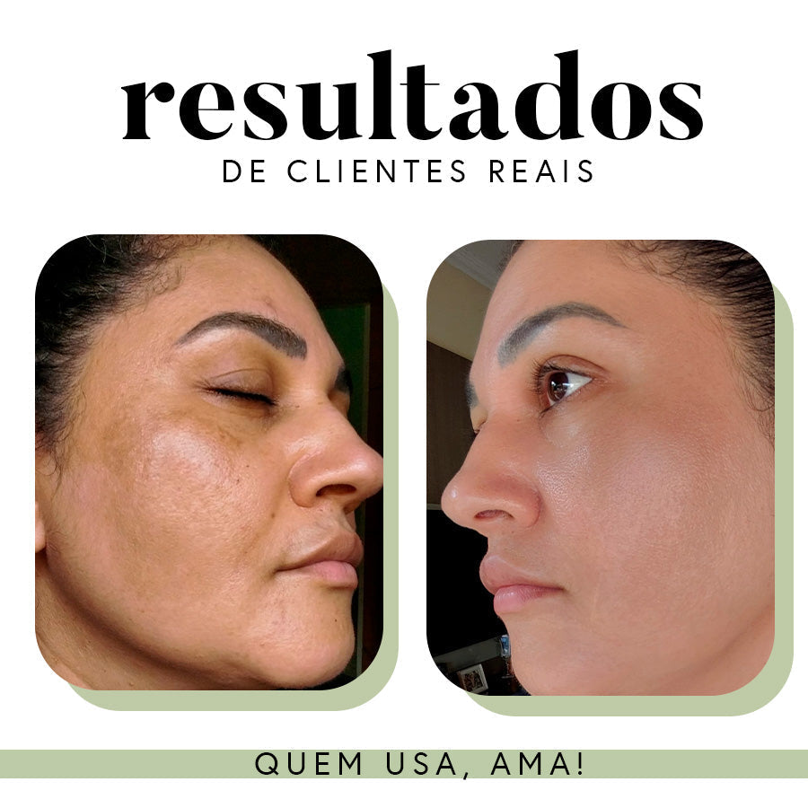 Fórmula Uniformizadora para Manchas e Melasma | 35 g