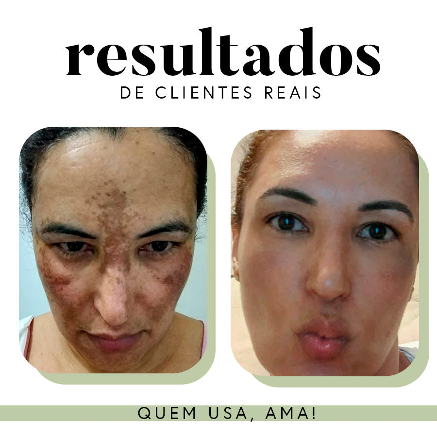 Fórmula Uniformizadora para Manchas e Melasma | 35 g
