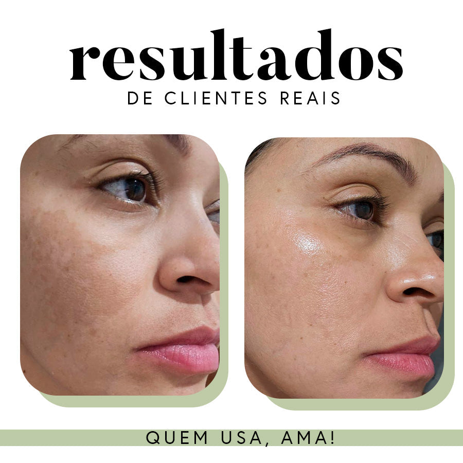 Fórmula Uniformizadora para Manchas e Melasma | 35 g