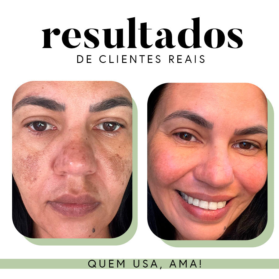 Fórmula Uniformizadora para Manchas e Melasma | 35 g