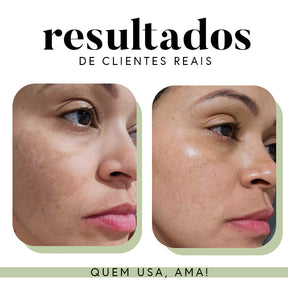 Fórmula Uniformizadora para Manchas e Melasma | 35 g